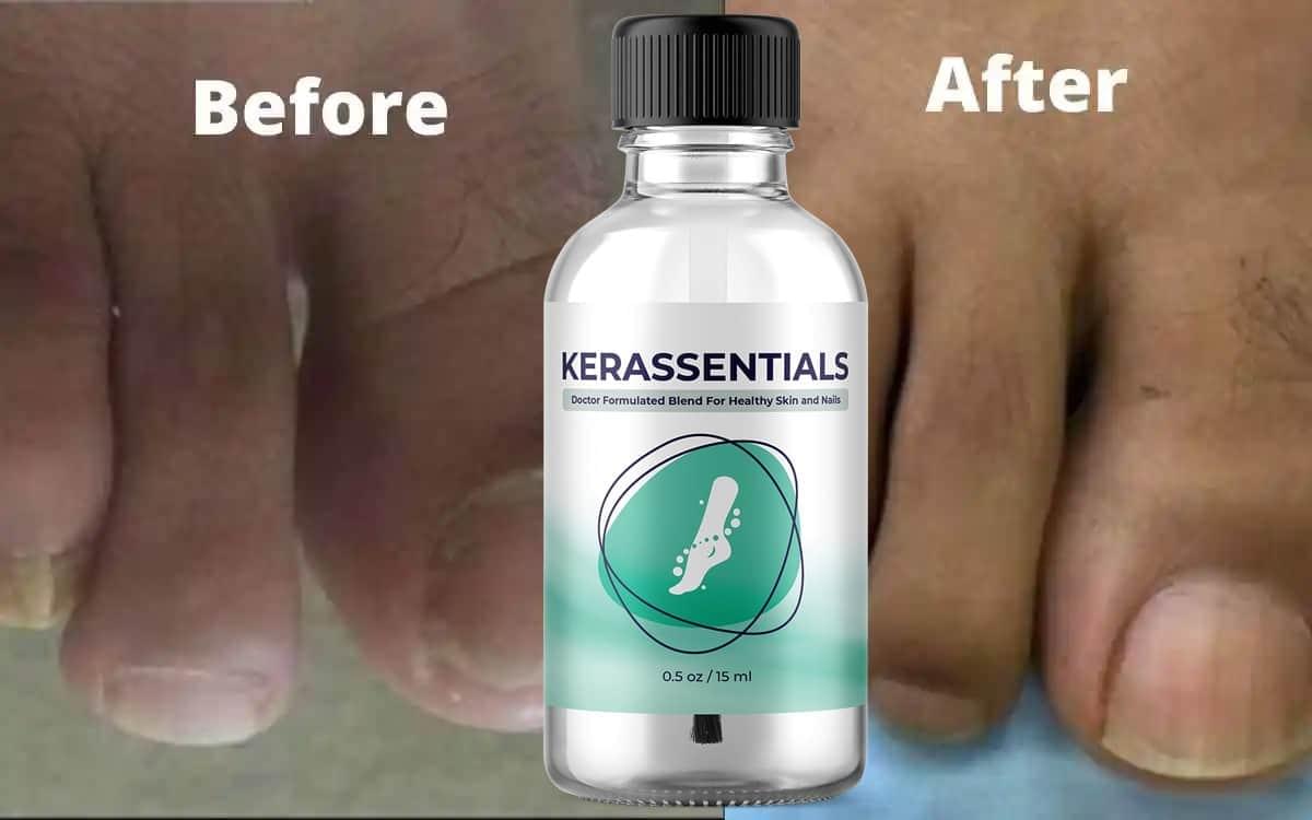Kerassentials before after